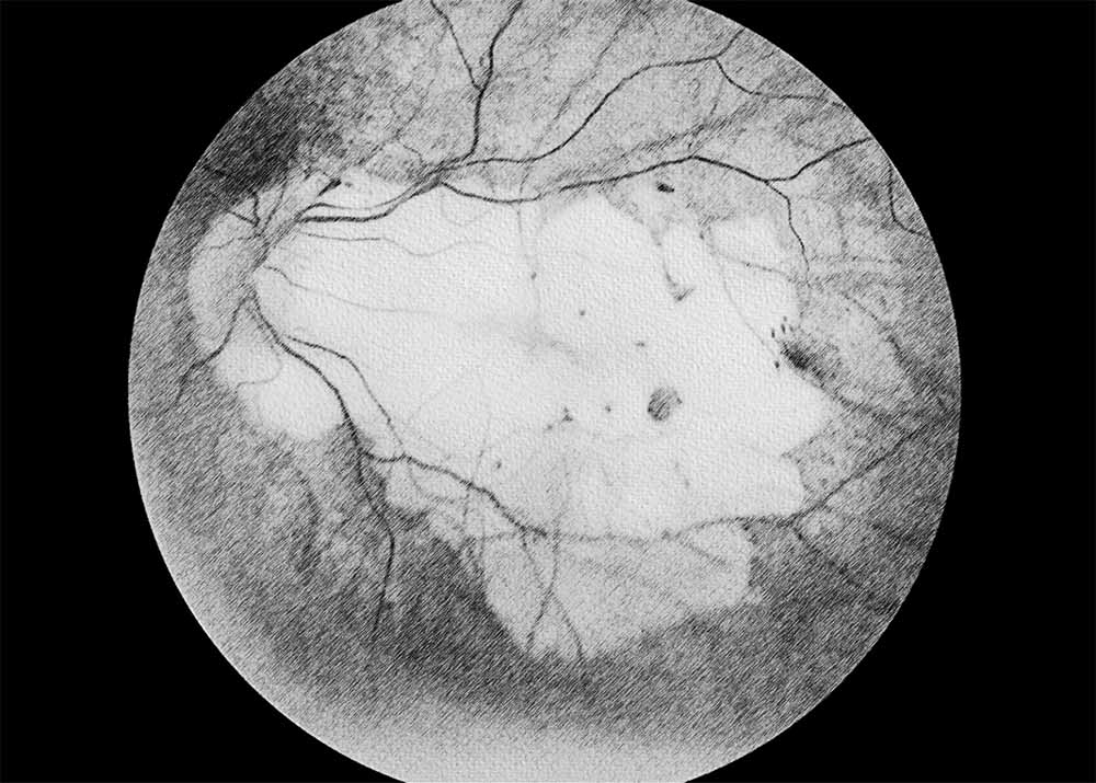 Myopic Macular Degeneration