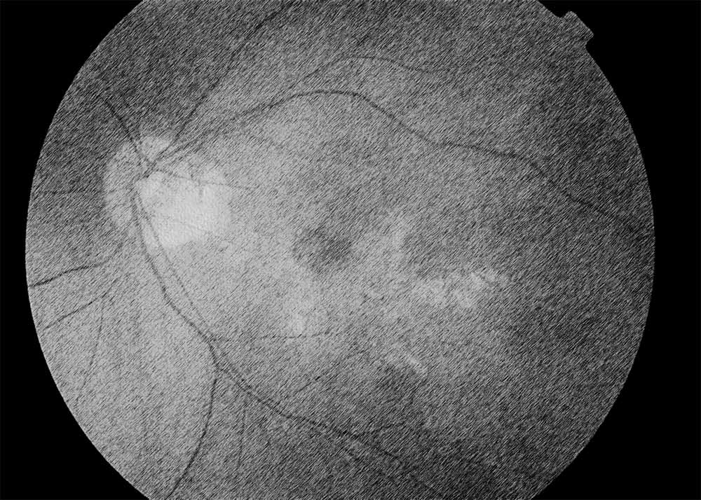 Myopic Macular Degeneration