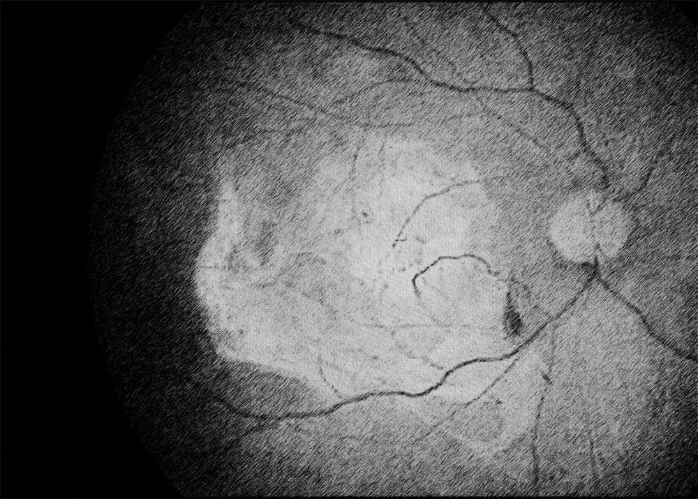 Neovascular or exudative AMD (also known as wet AMD)