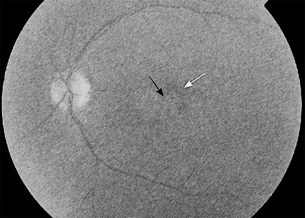 Neovascular or exudative AMD (also known as wet AMD)