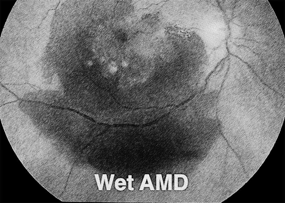 Neovascular or exudative AMD (also known as wet AMD)