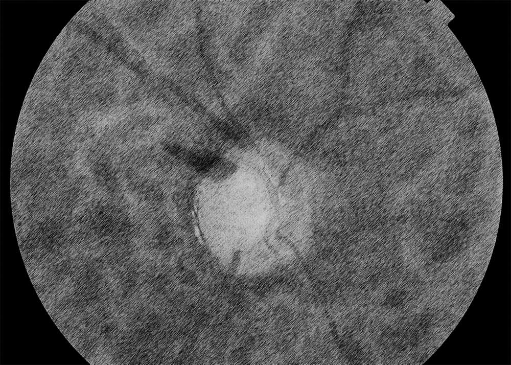 Normal-Tension Glaucoma