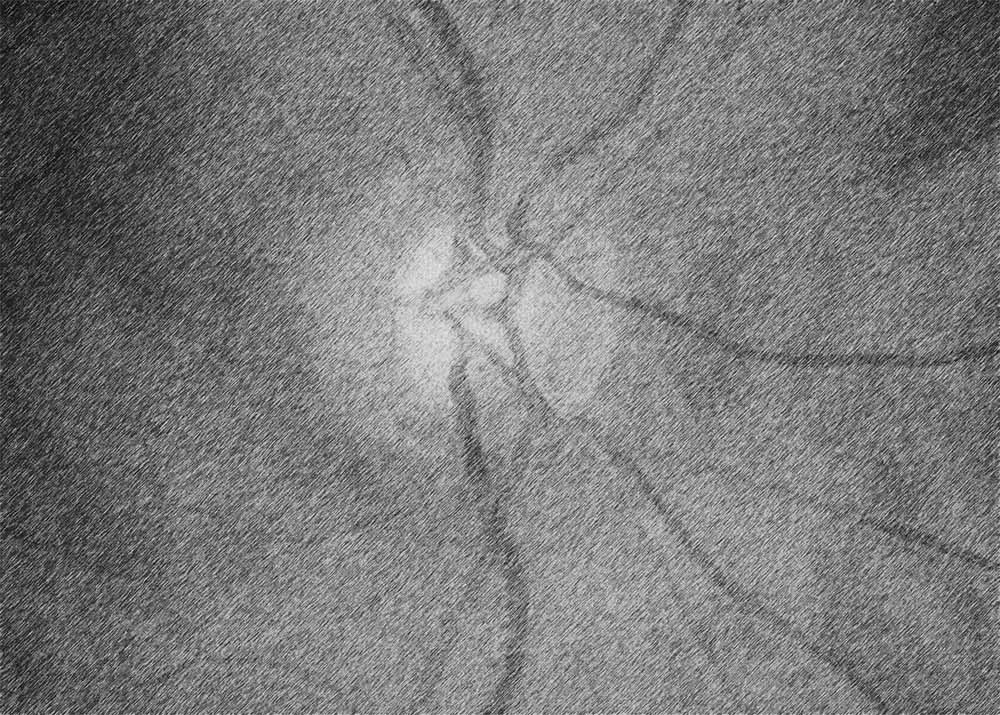 Normal-Tension Glaucoma