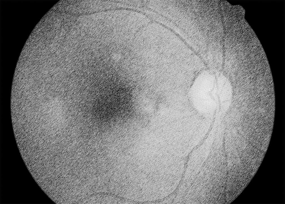 Normal-Tension Glaucoma