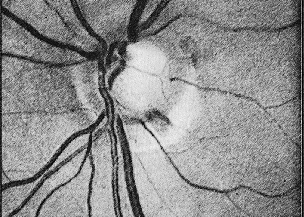 Normal-Tension Glaucoma