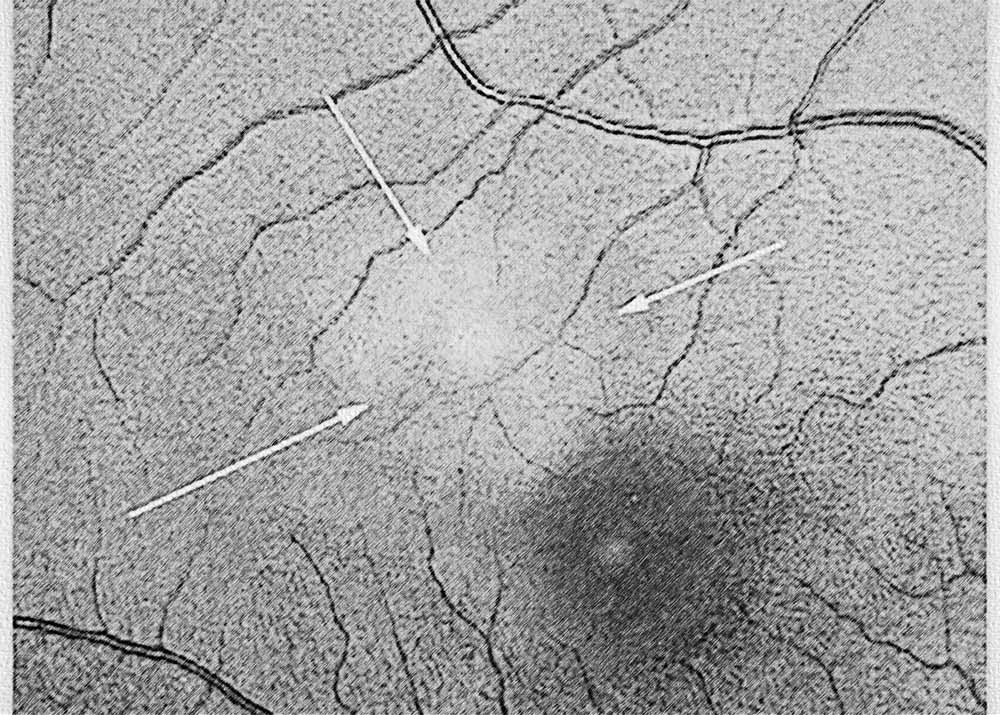 Ocular Histoplasmosis Syndrome