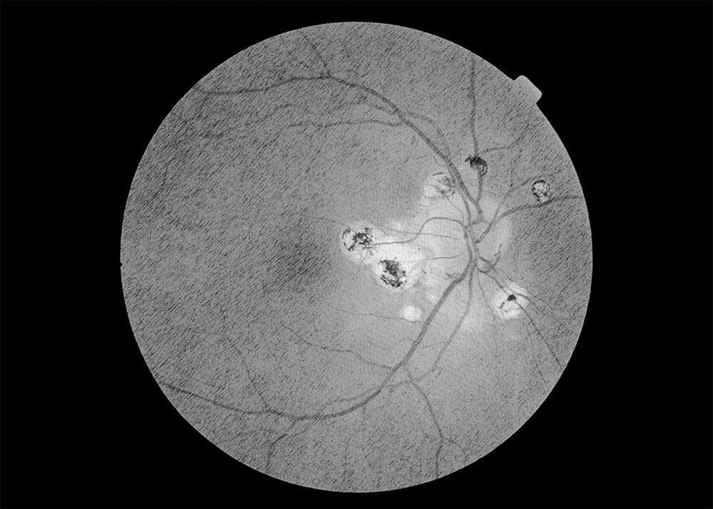 Ocular Histoplasmosis Syndrome (OHS) (2) Ocular Histoplasmosis Syndrome