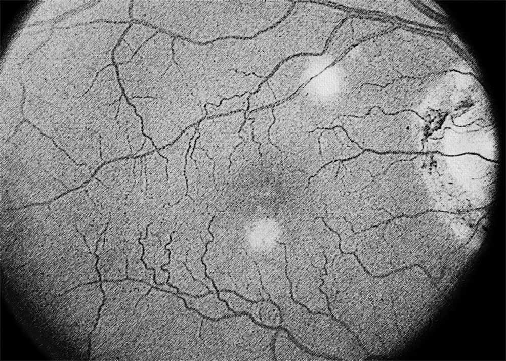 Ocular Histoplasmosis Syndrome (OHS) (3) Ocular Histoplasmosis Syndrome
