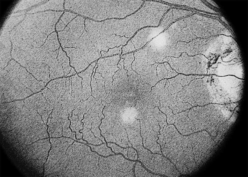 Ocular Histoplasmosis Syndrome