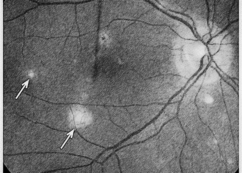 Ocular Histoplasmosis Syndrome (OHS) (4) Ocular Histoplasmosis Syndrome
