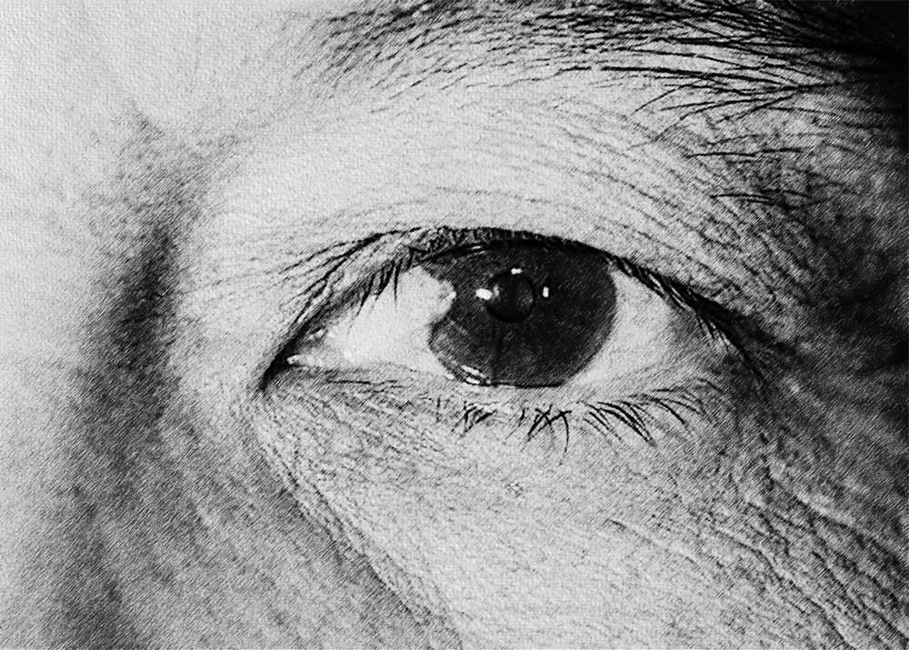 Ocular hypertension (1) Ocular hypertension