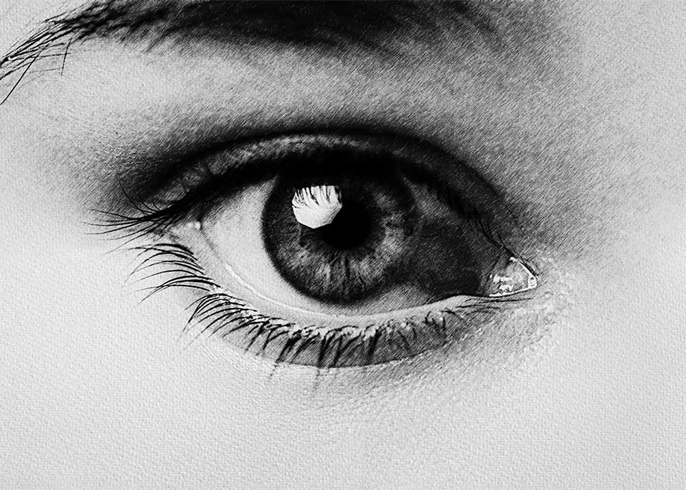 Ocular hypertension (3) Ocular hypertension