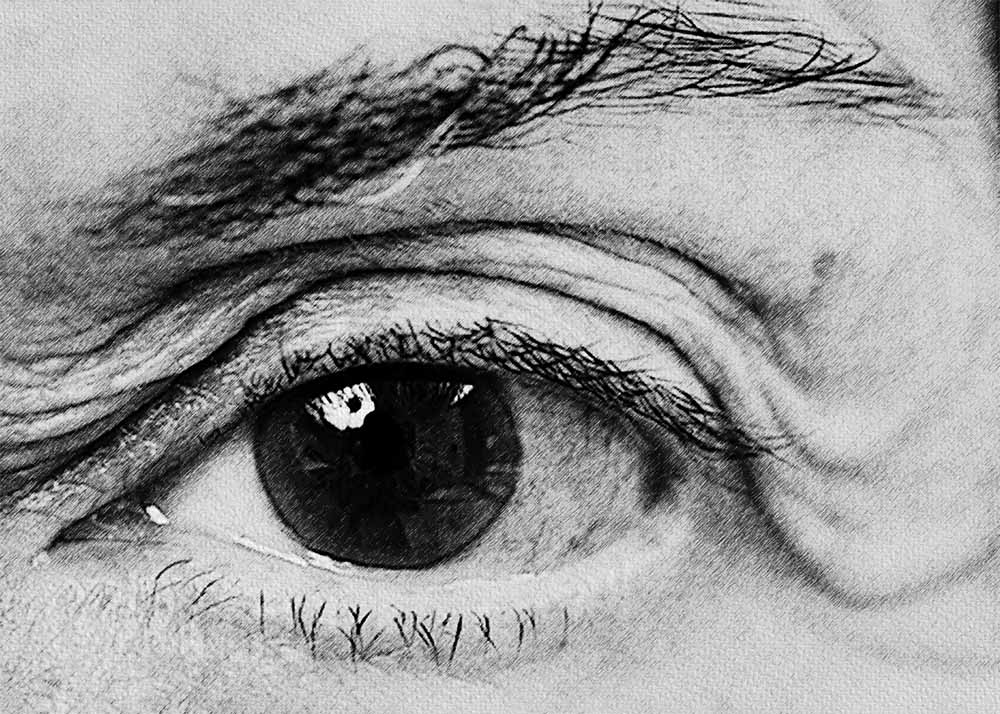 OpenAngle Glaucoma (1) Open-Angle Glaucoma