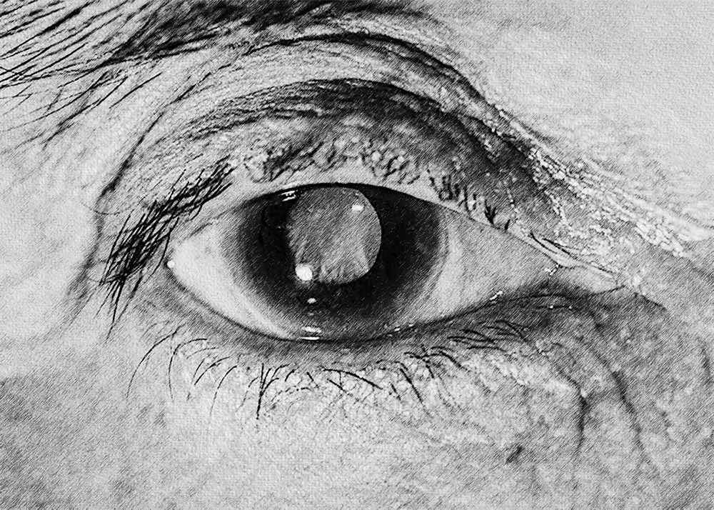 OpenAngle Glaucoma (2) Open-Angle Glaucoma