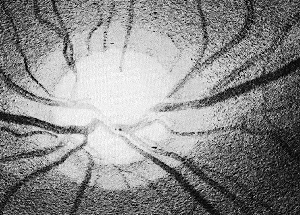 Open-Angle Glaucoma