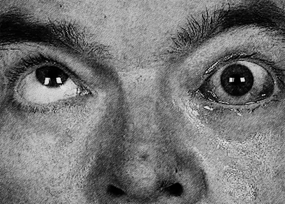 Ophthalmoplegia