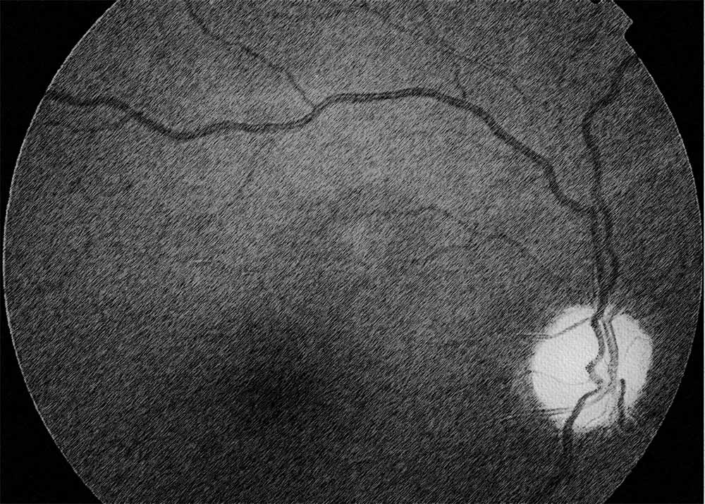 Optic Nerve Atrophy