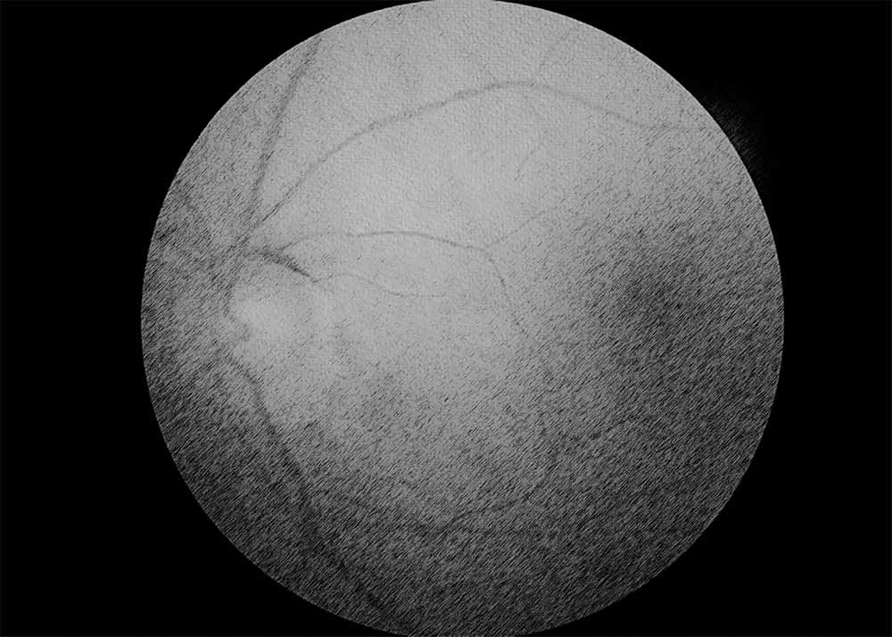 Optic Nerve Atrophy