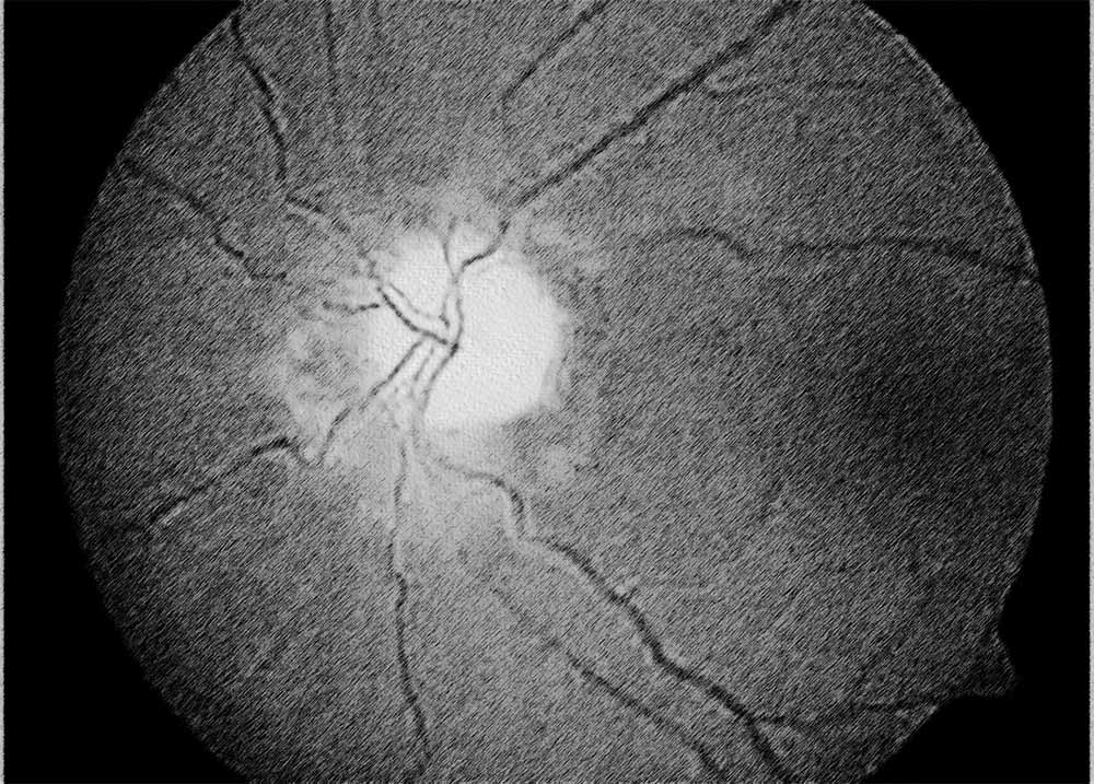 Optic Nerve Atrophy