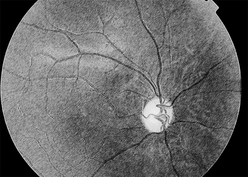 Optic Nerve Atrophy