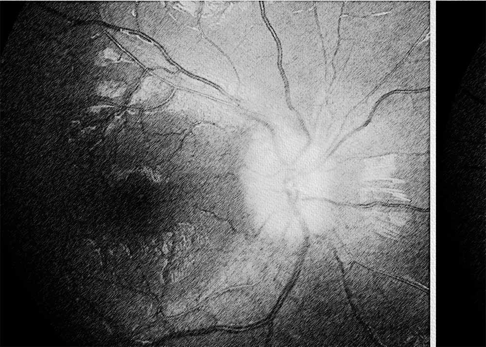 Optic Nerve Glioma