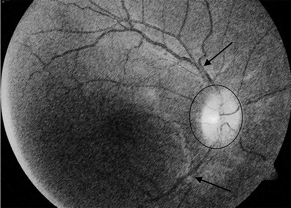 Optic Nerve Glioma