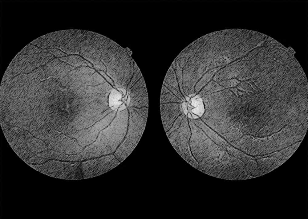 Optic Nerve Glioma