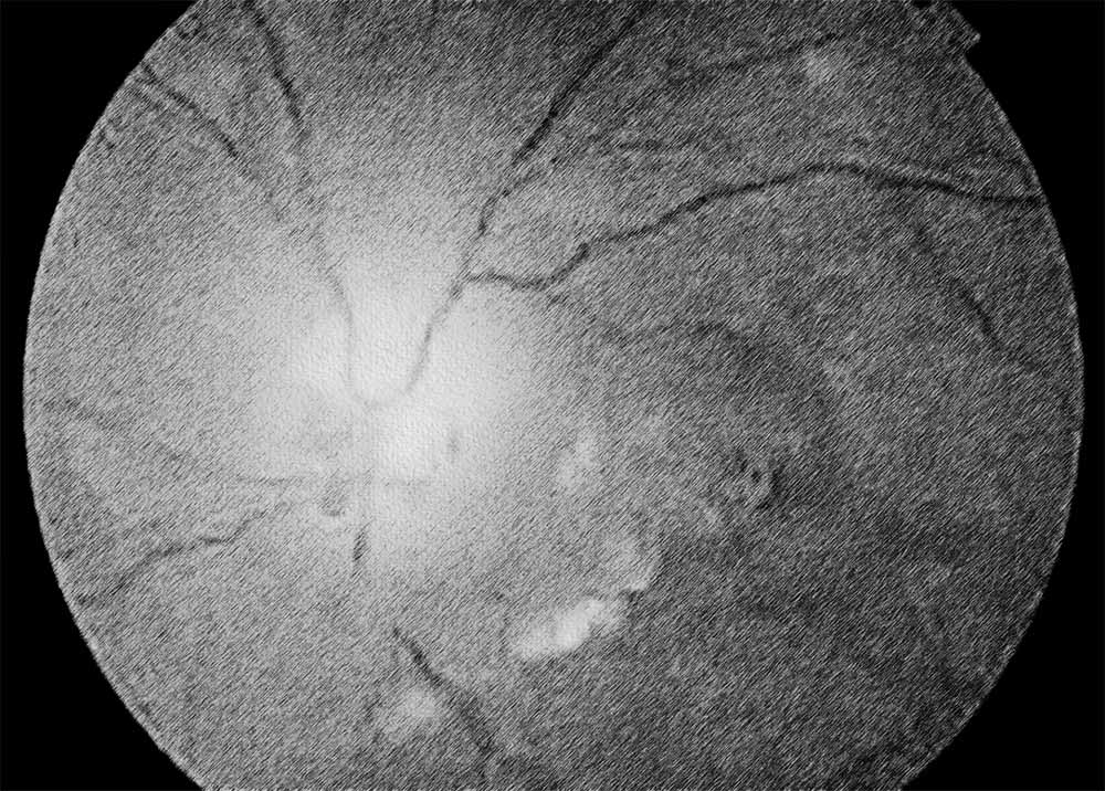 Optic Nerve Glioma