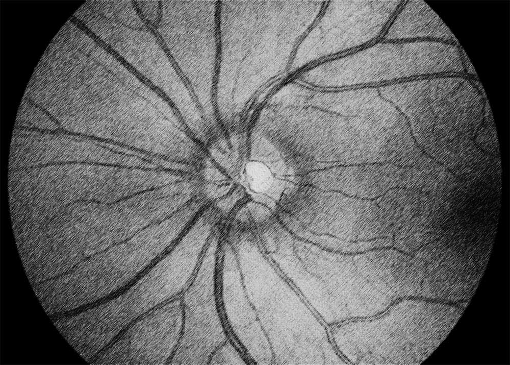 Optic Neuritis