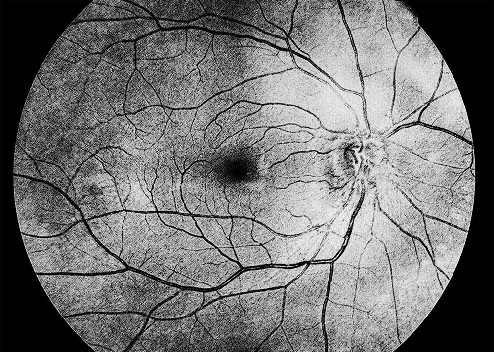 Optic Neuritis (2) Optic Neuritis