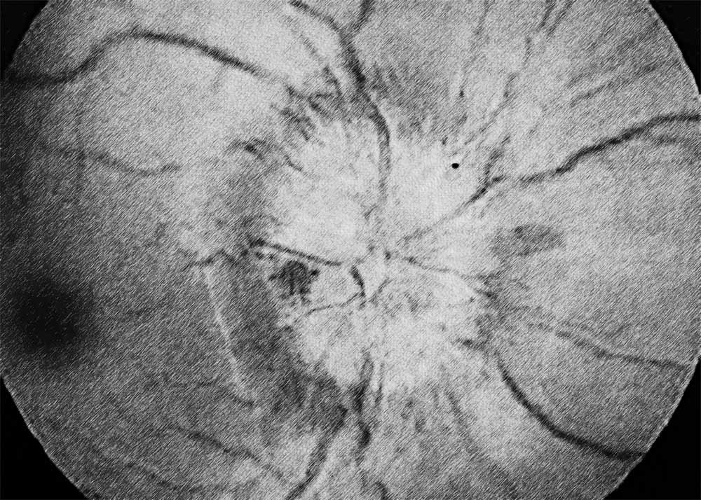 Optic neuritis (1) Optic Neuritis