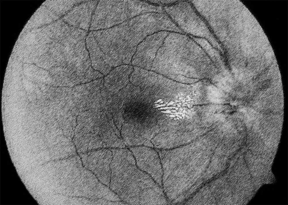 Optic neuritis (3) Optic Neuritis