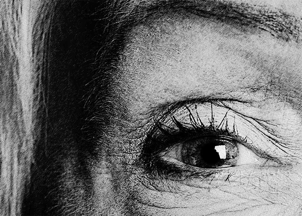 Optic neuritis Optic Neuritis