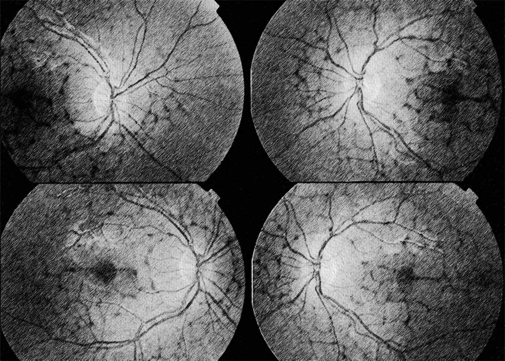 Pattern Dystrophy
