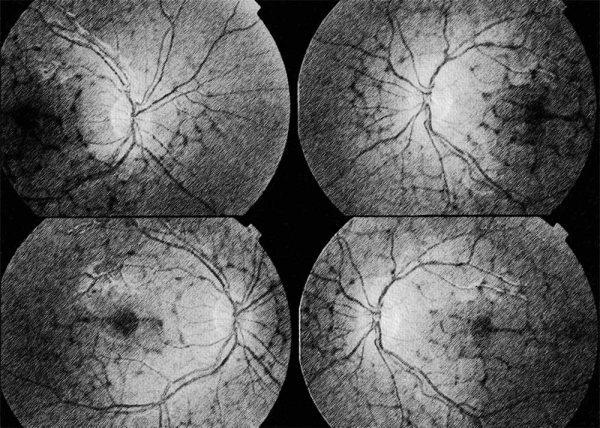 Pattern Dystrphy Oct Pattern Dystrophy – Retyne.com