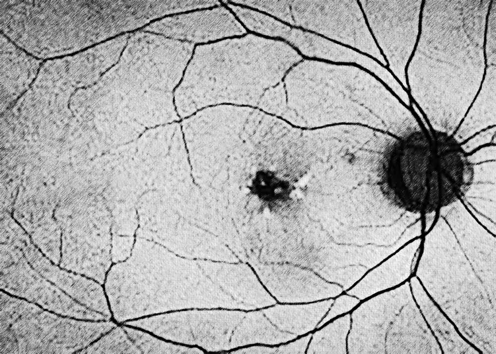 Pattern Dystrophy