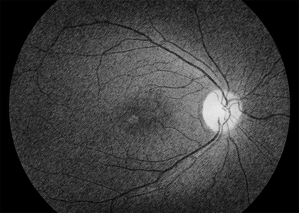 Pattern Dystrophy