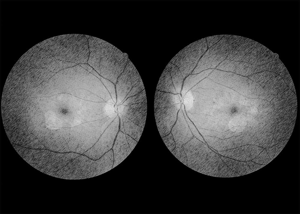 Pattern Dystrophy