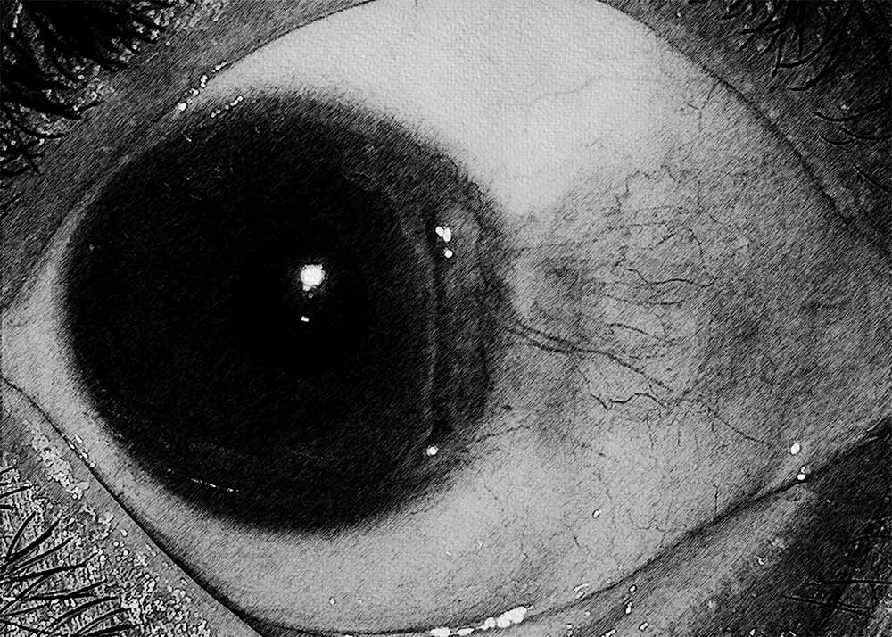 Peripheral Ulcerative Keratitis (1) Peripheral Ulcerative Keratitis