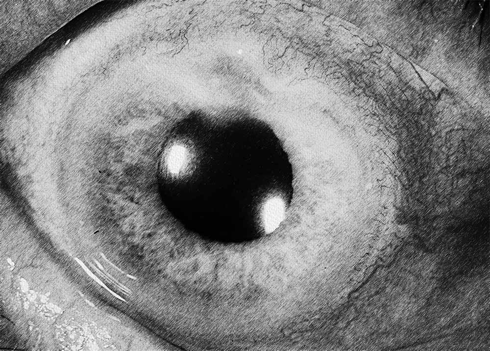 Peripheral Ulcerative Keratitis