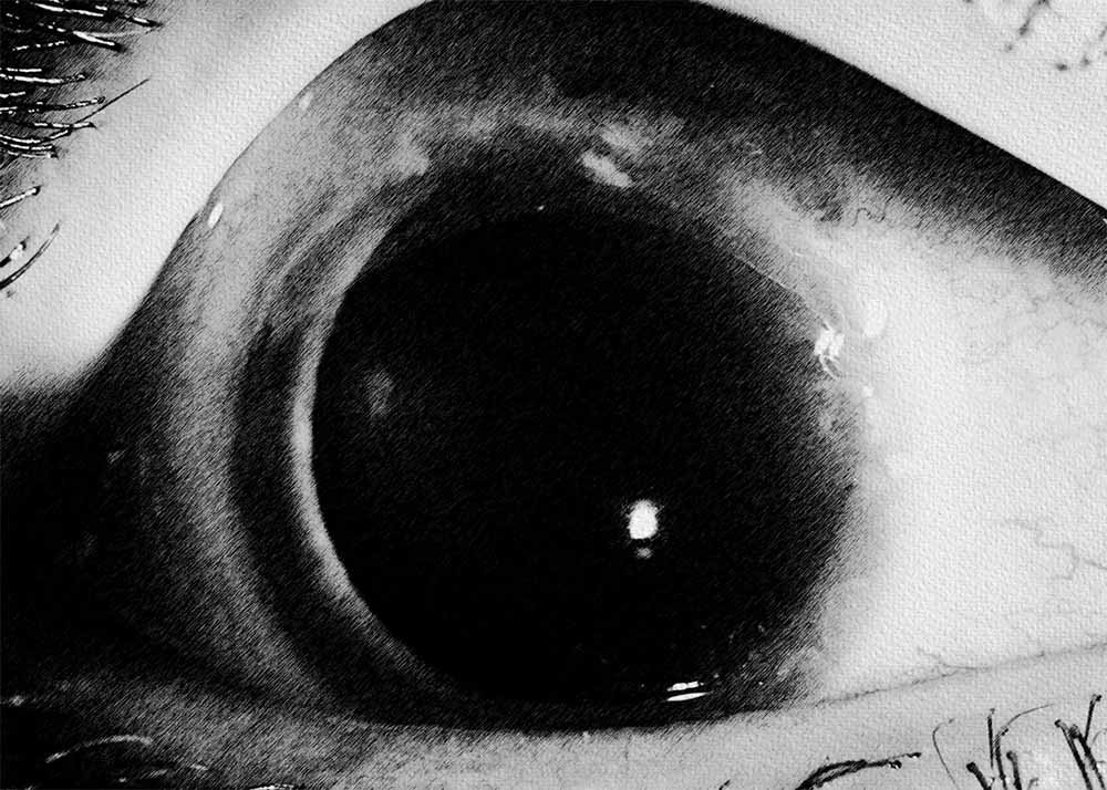 Peripheral Ulcerative Keratitis