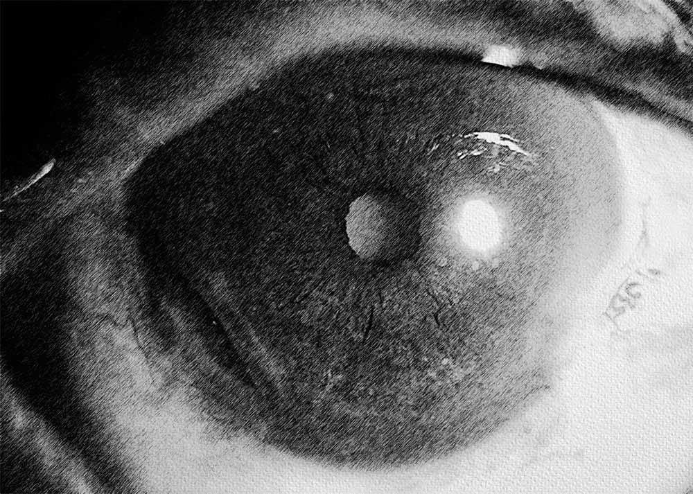 Peripheral Ulcerative Keratitis (4) Peripheral Ulcerative Keratitis