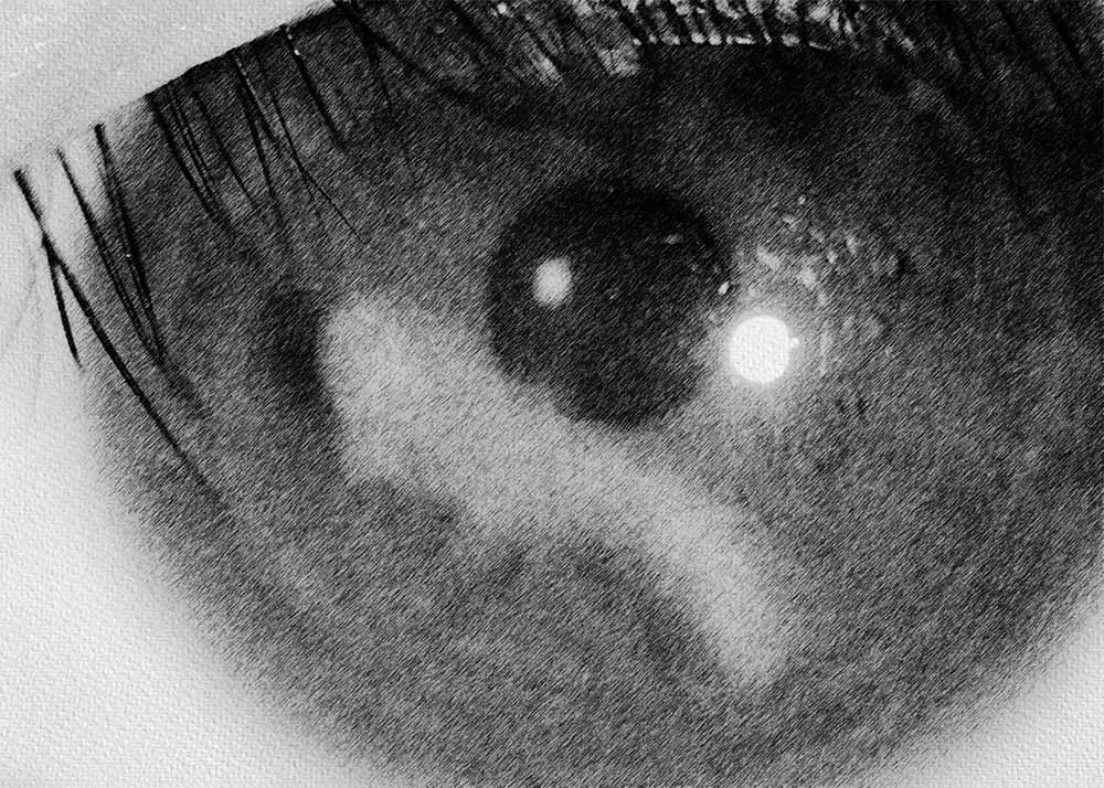 Phlyctenular Keratoconjunctivitis