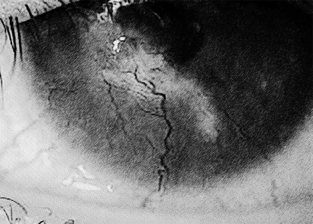 Phlyctenular Keratoconjunctivitis