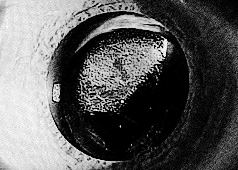 pco posterior capsule opacification icd 10