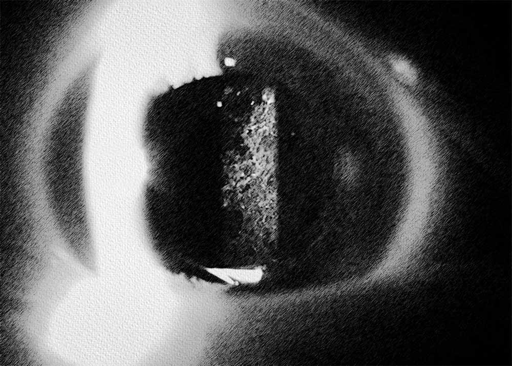 Posterior capsule opacification (PCO)