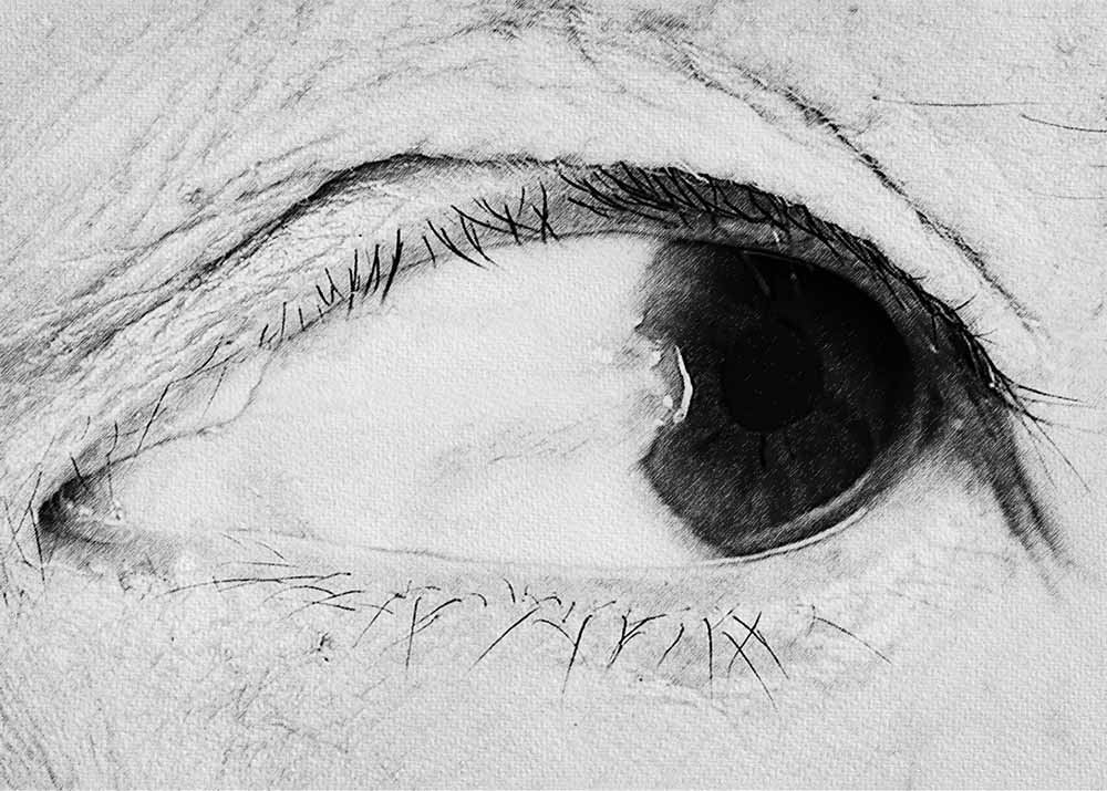 Pterygium