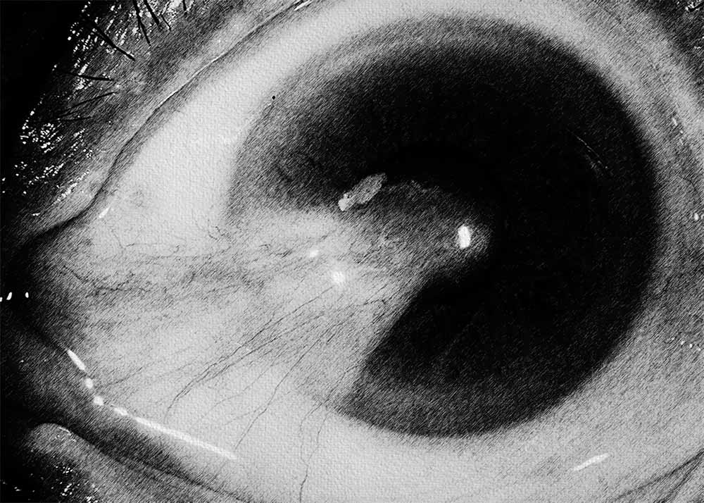 Pterygium