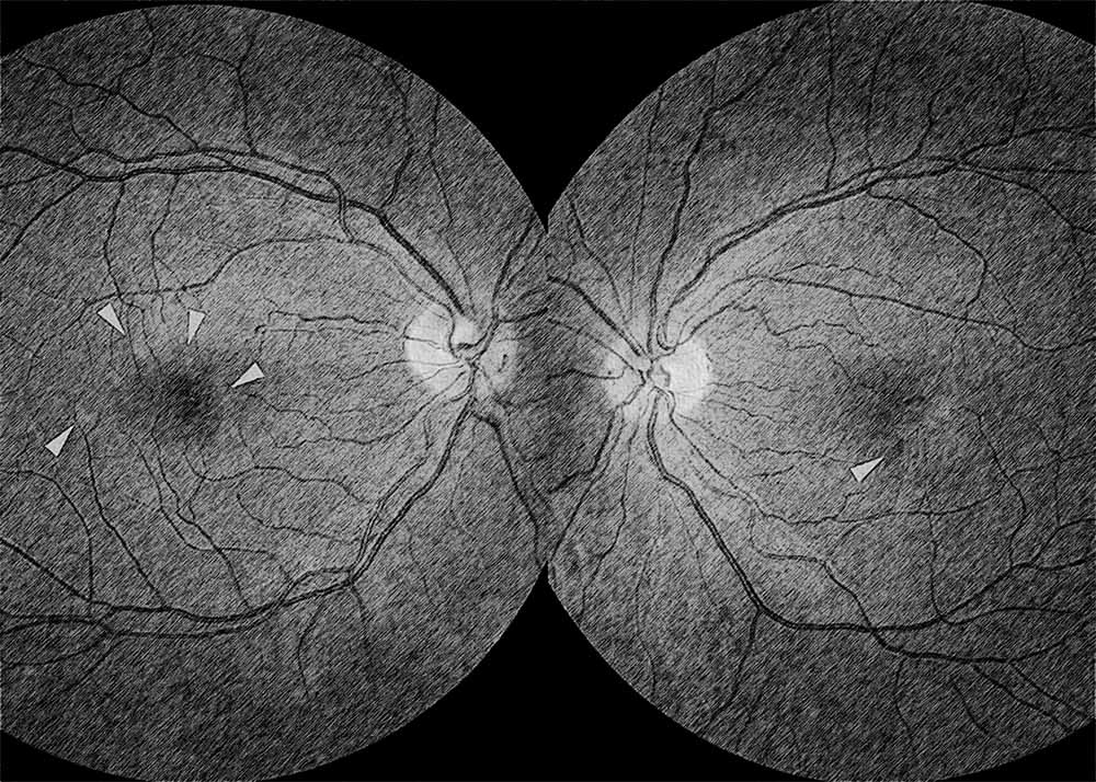 Punctate Inner Choroidopathy