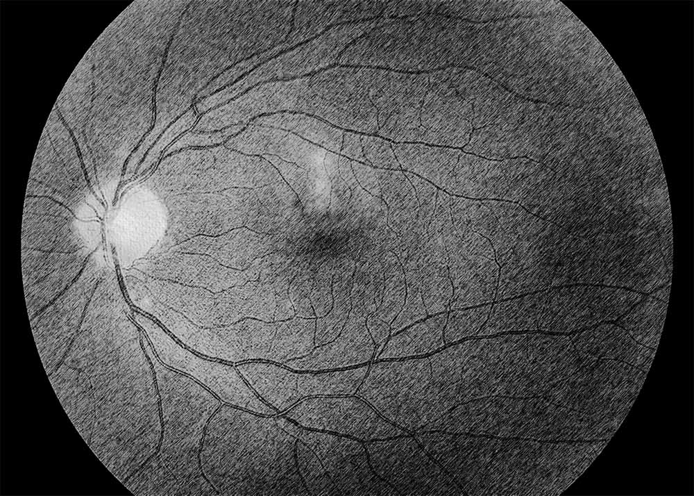 Punctate Inner Choroidopathy